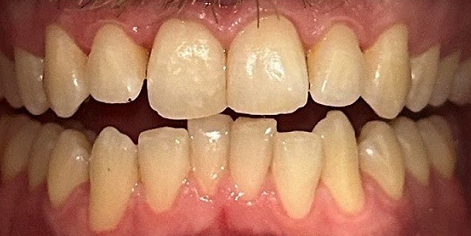 Before