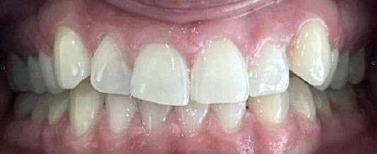 Before