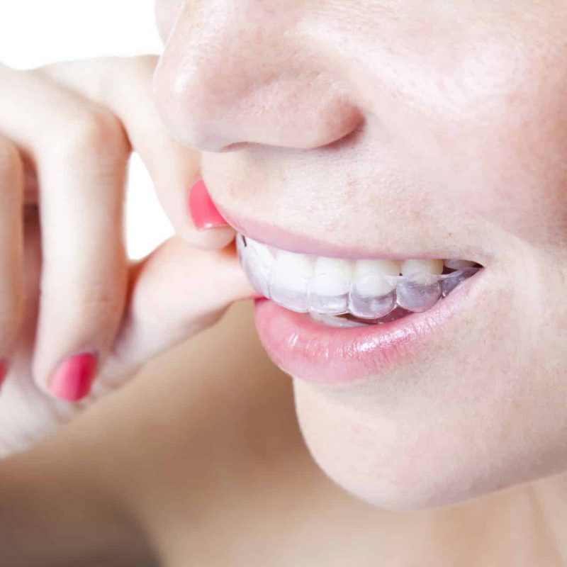 Close-up of young woman wearing clear braces.