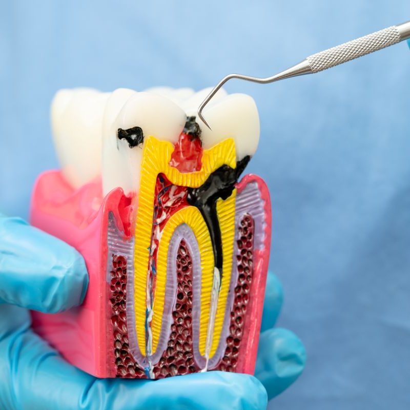 Root Canal